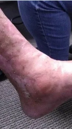 Heel ulcer, open wound. Brown skin with a deep, red sore. Week 0.