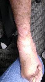 Foot with a large, open wound, wrapped in clear dressing; labeled 