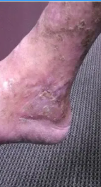 Foot with a deep, open wound on the heel, surrounded by discolored skin.