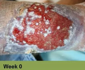 Foot with open wound on big toe. The wound has red tissue and a yellow-white border.