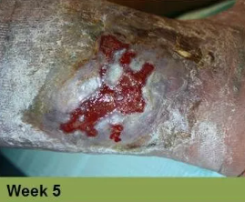 Foot with a deep, red ulcer on the ball, with slight discoloration; week 2 of treatment.
