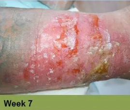Foot with an open sore on the toe, showing redness and potential tissue damage; the image has a week 5 caption.