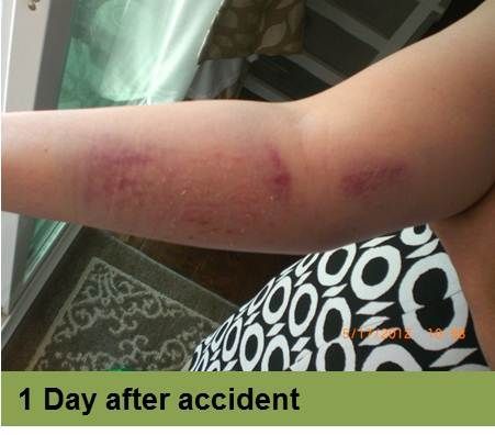 Foot with open wound on big toe. The wound has red tissue and a yellow-white border.