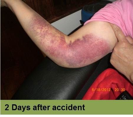 Foot with a deep, red ulcer on the ball, with slight discoloration; week 2 of treatment.