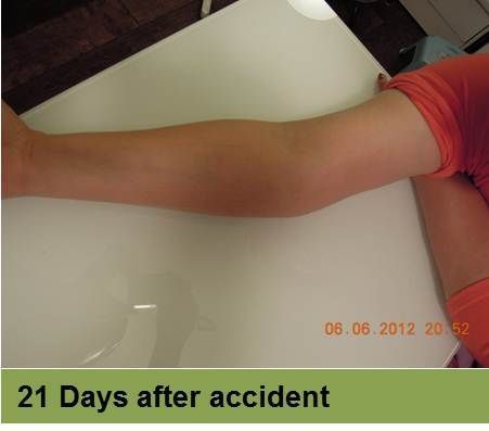 Foot with healing wounds, possibly diabetic, at week 6. Light skin, indoors setting.