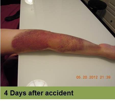 Foot with an open sore on the toe, showing redness and potential tissue damage; the image has a week 5 caption.