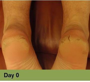 Foot with open wound on big toe. The wound has red tissue and a yellow-white border.