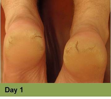 Foot with a deep, red ulcer on the ball, with slight discoloration; week 2 of treatment.