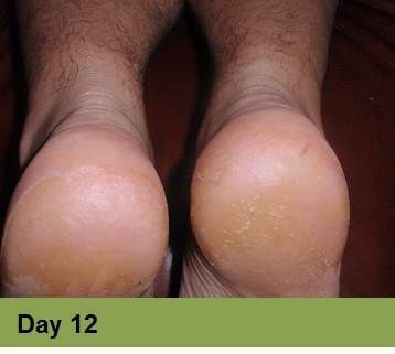 Foot with healing wounds, possibly diabetic, at week 6. Light skin, indoors setting.