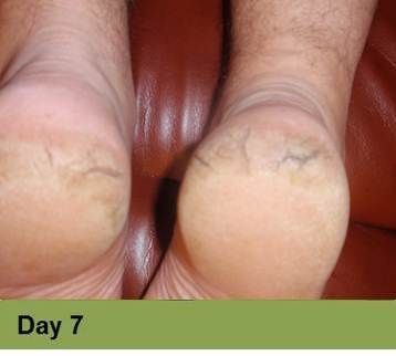 Foot with an open sore on the toe, showing redness and potential tissue damage; the image has a week 5 caption.