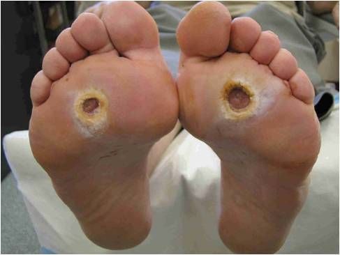 Soles of two feet with open, circular sores on the ball of each foot.