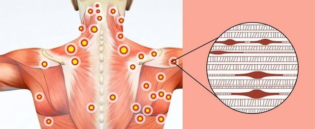 Trigger Point Grand Rond Muscle Trigger Point Anatomy Untangle That Knot! Learn About Trapezius