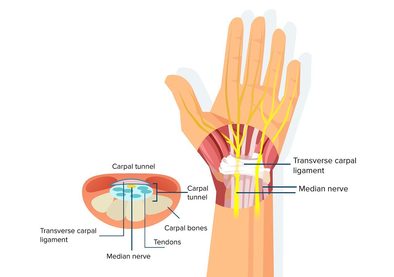 Advanced Physicians explains carpal tunnel syndrome