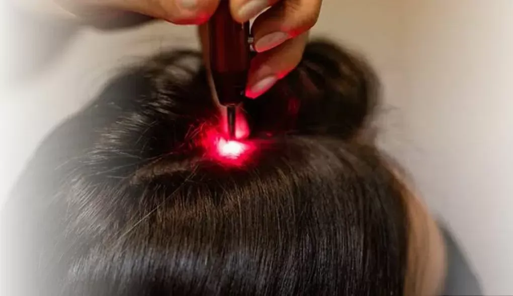 Terapia Capilar - IPL