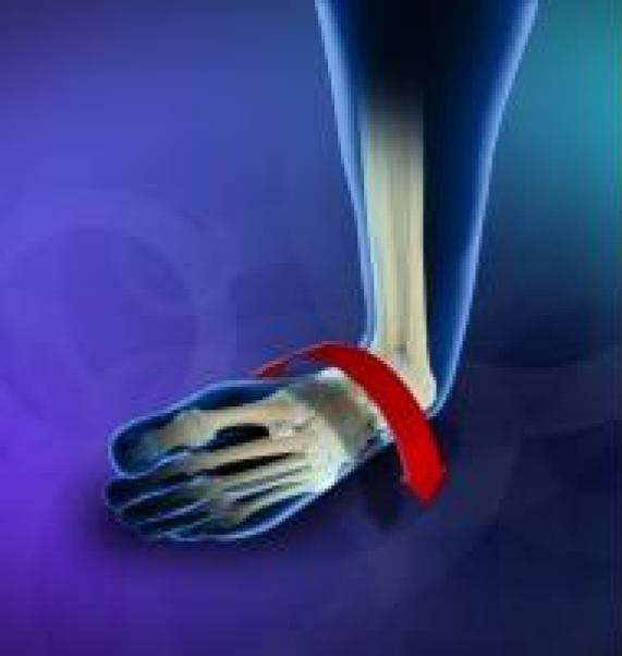 Understanding Ankle Instability: Causes, Symptoms, and Treatment