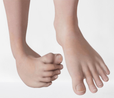 Club Foot Bowral Orthopaedics