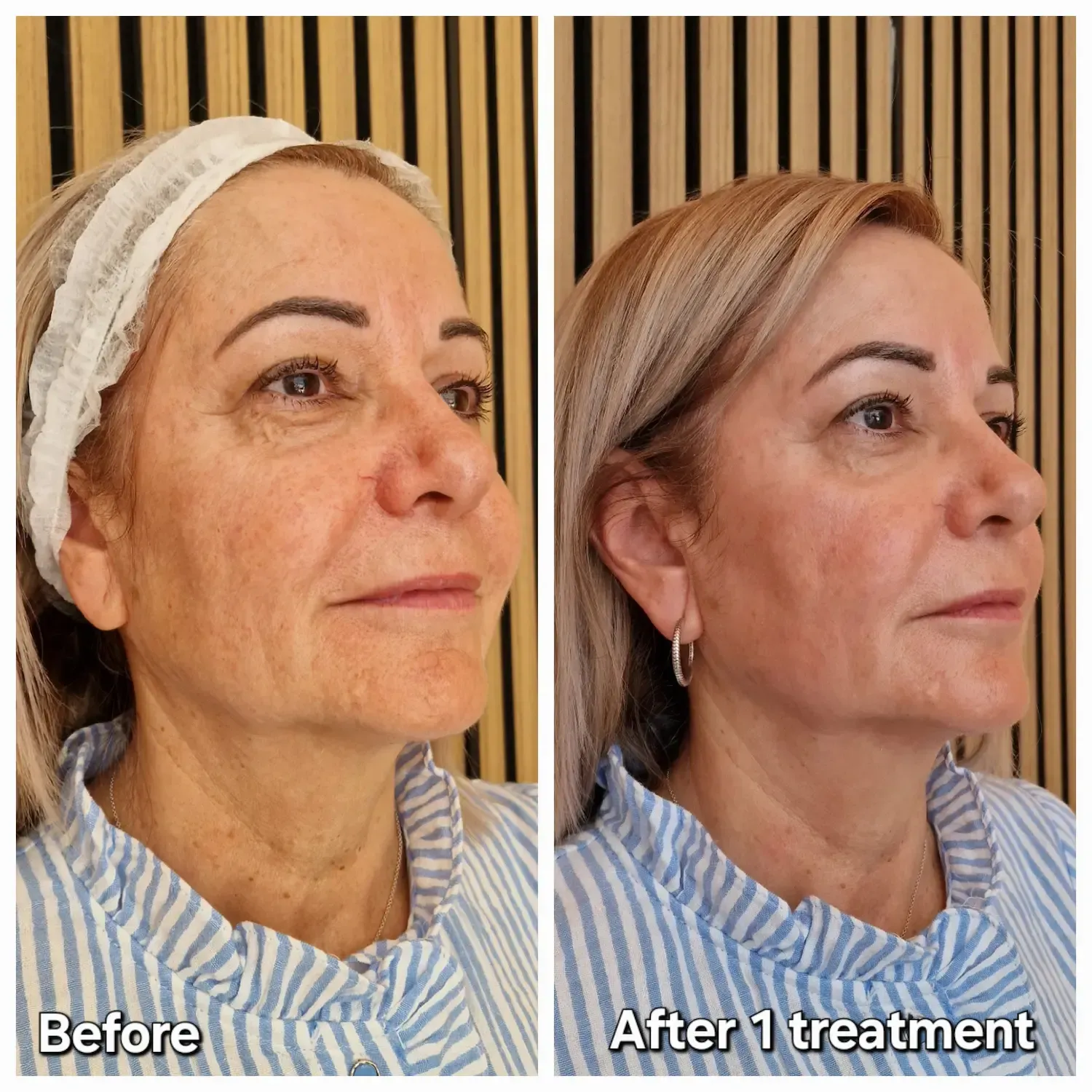 Lady before after sagging skin