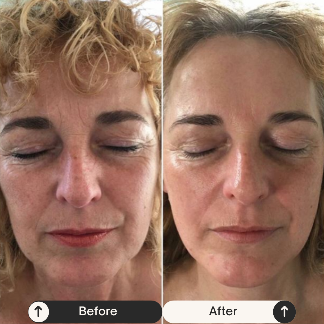 Resultaat van een premium huidbehandeling in de kliniek