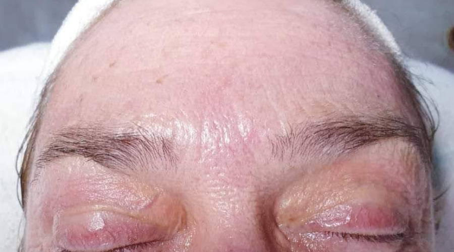 Oxygeneo forehead after