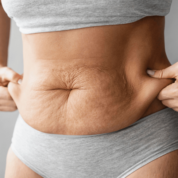 Body regeneration treatment stretch marks