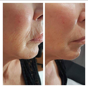 PhotoBiodynamic Therapy Acne Neck