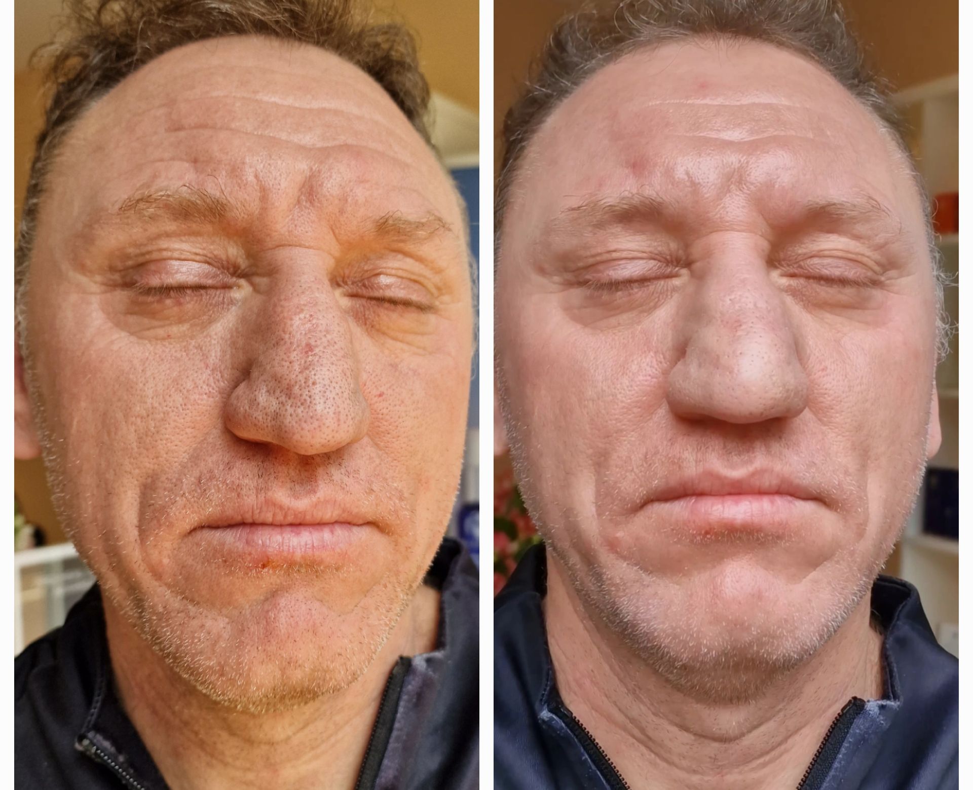 PhotoBiodynamic Therapy Acne Neck