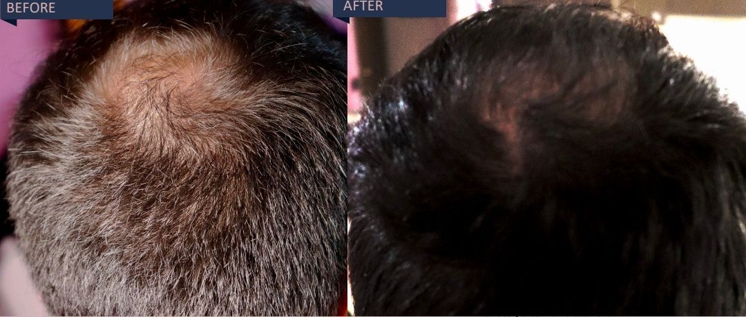 Scalp and hair treatments for men at Gustil Aesthetics