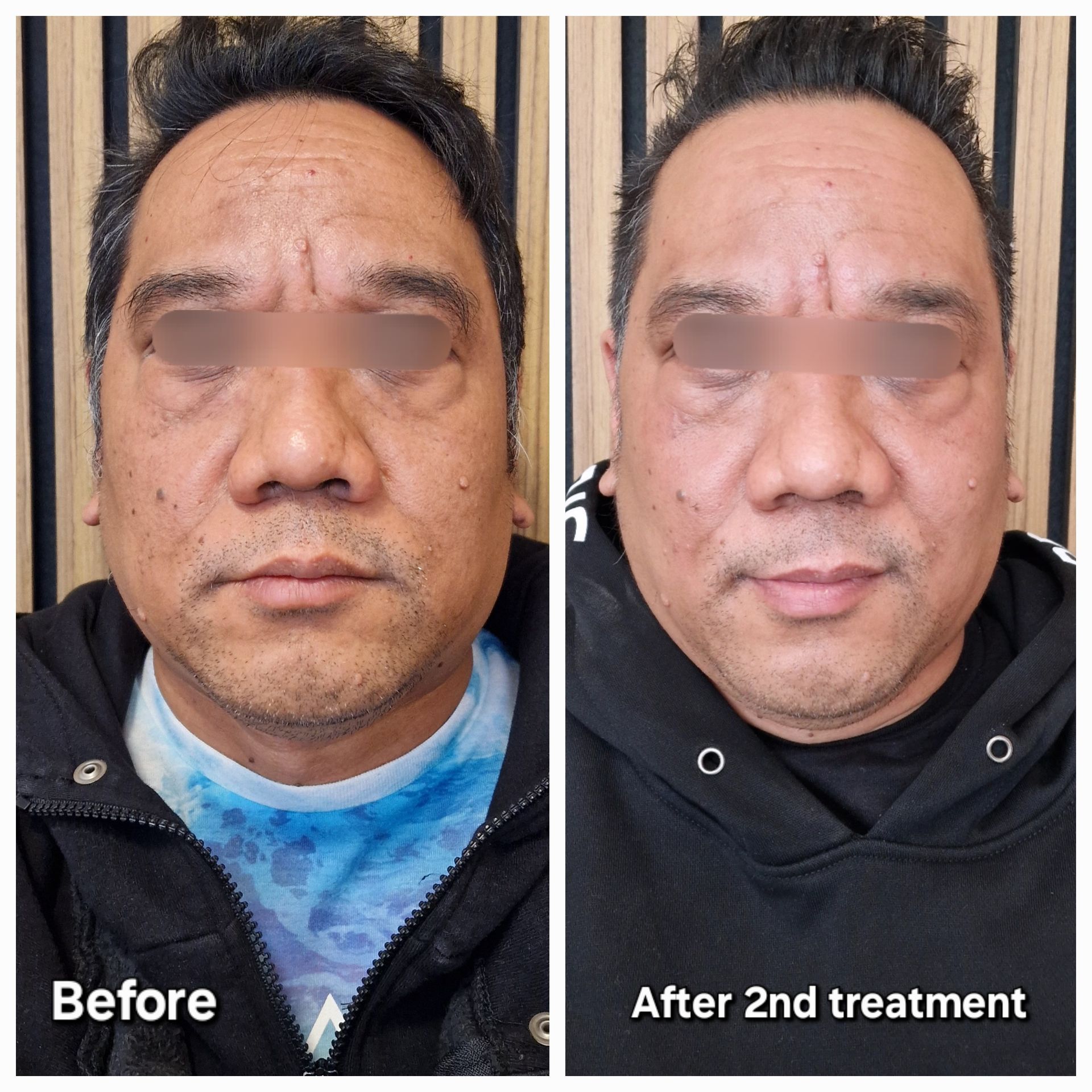 Voor en na OxyGeneo case 2