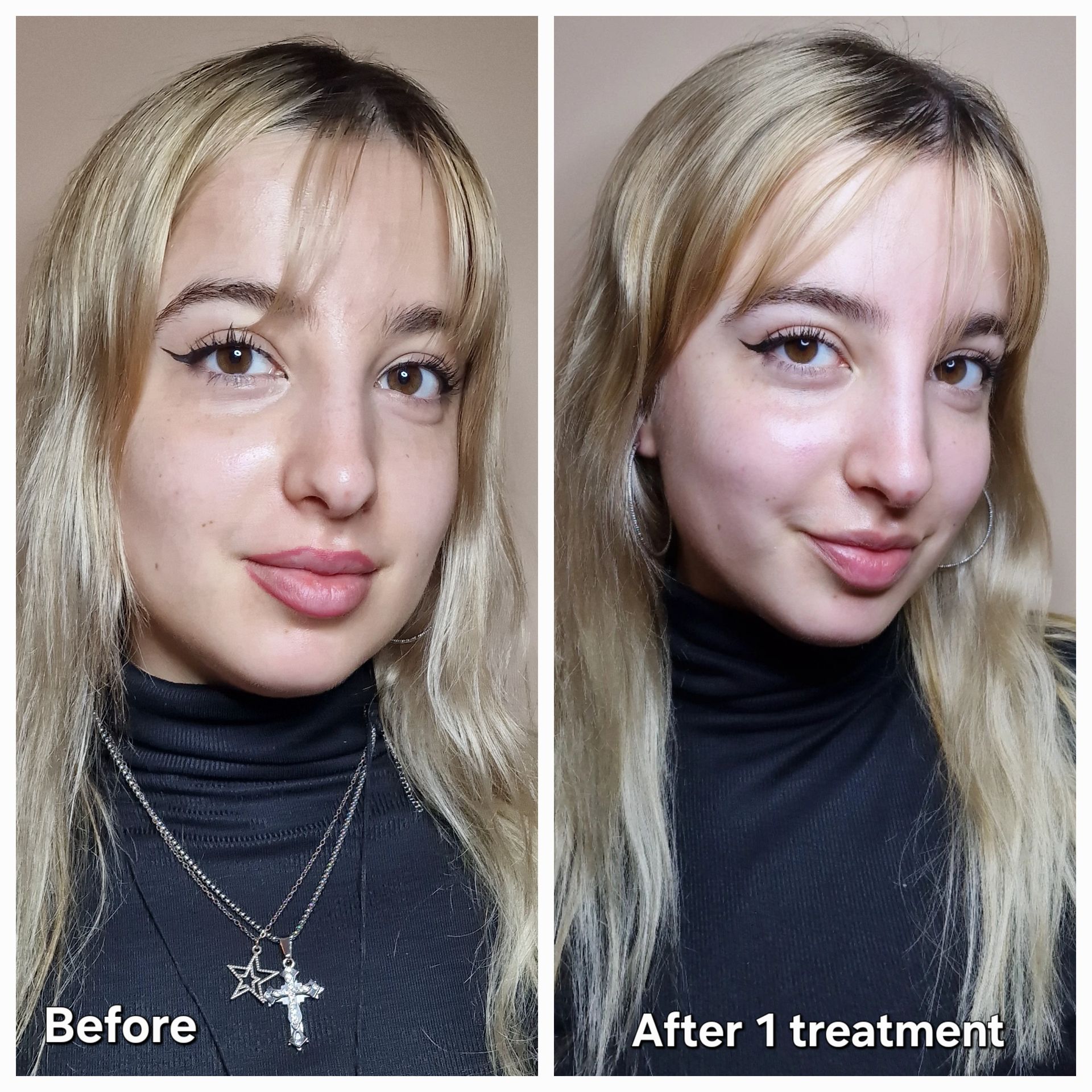 Before and after Fire and Ice Facial