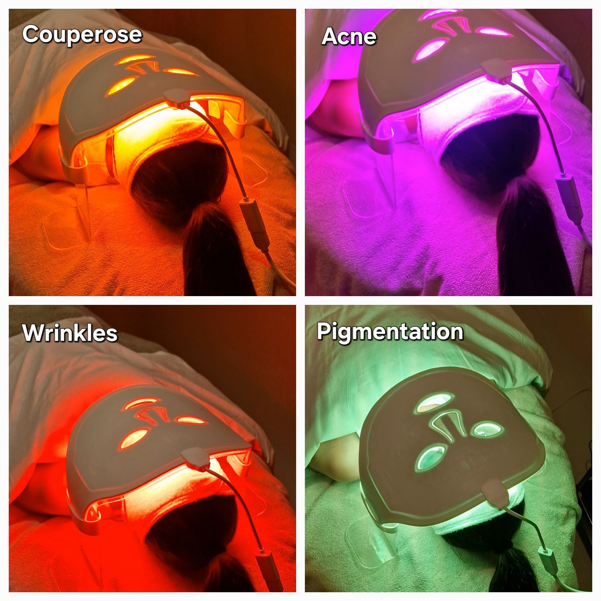 PhotoBioDynamic Therapy to treat skin concerns like Acne in Amsterdam