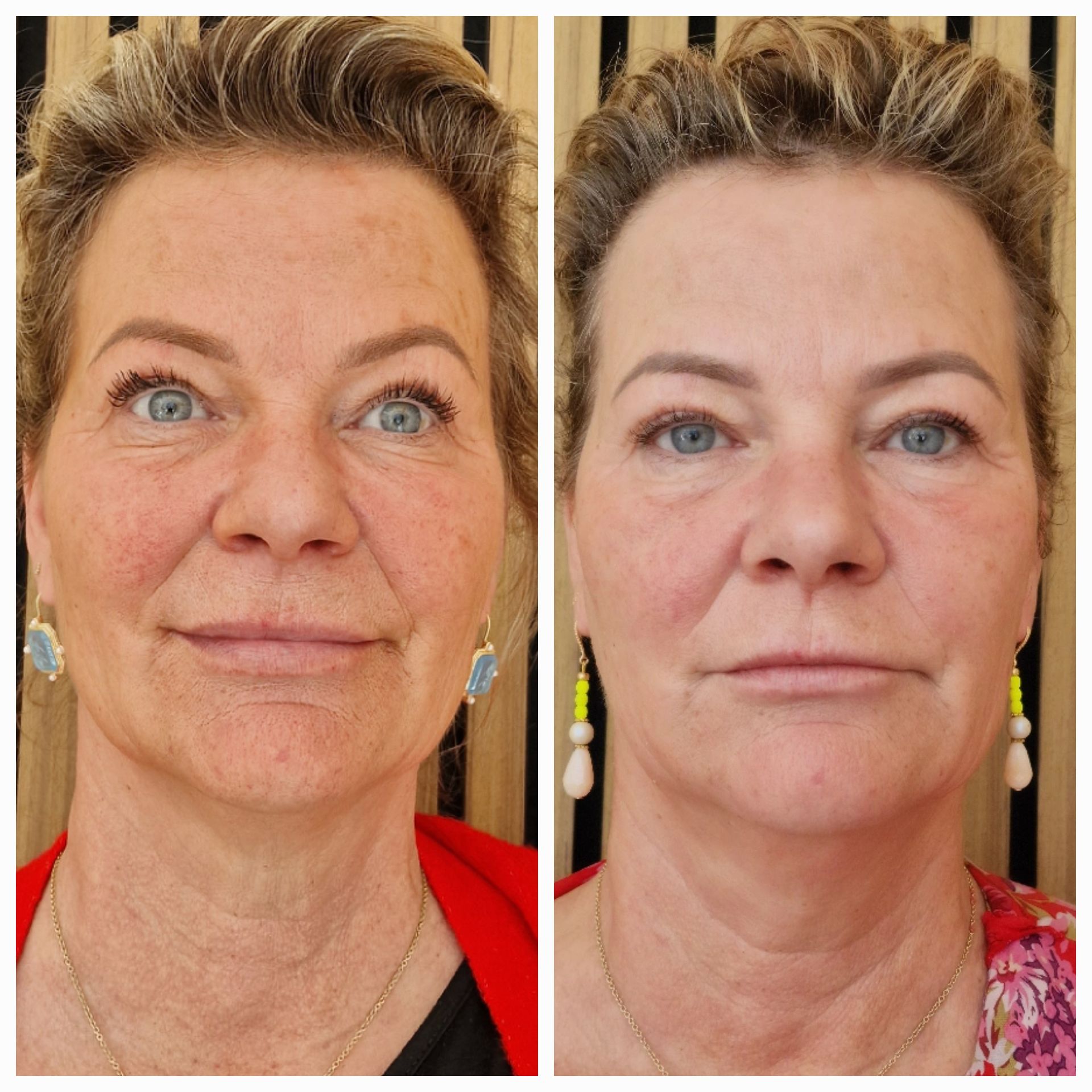 Before and after Gustil Facial Lifting
