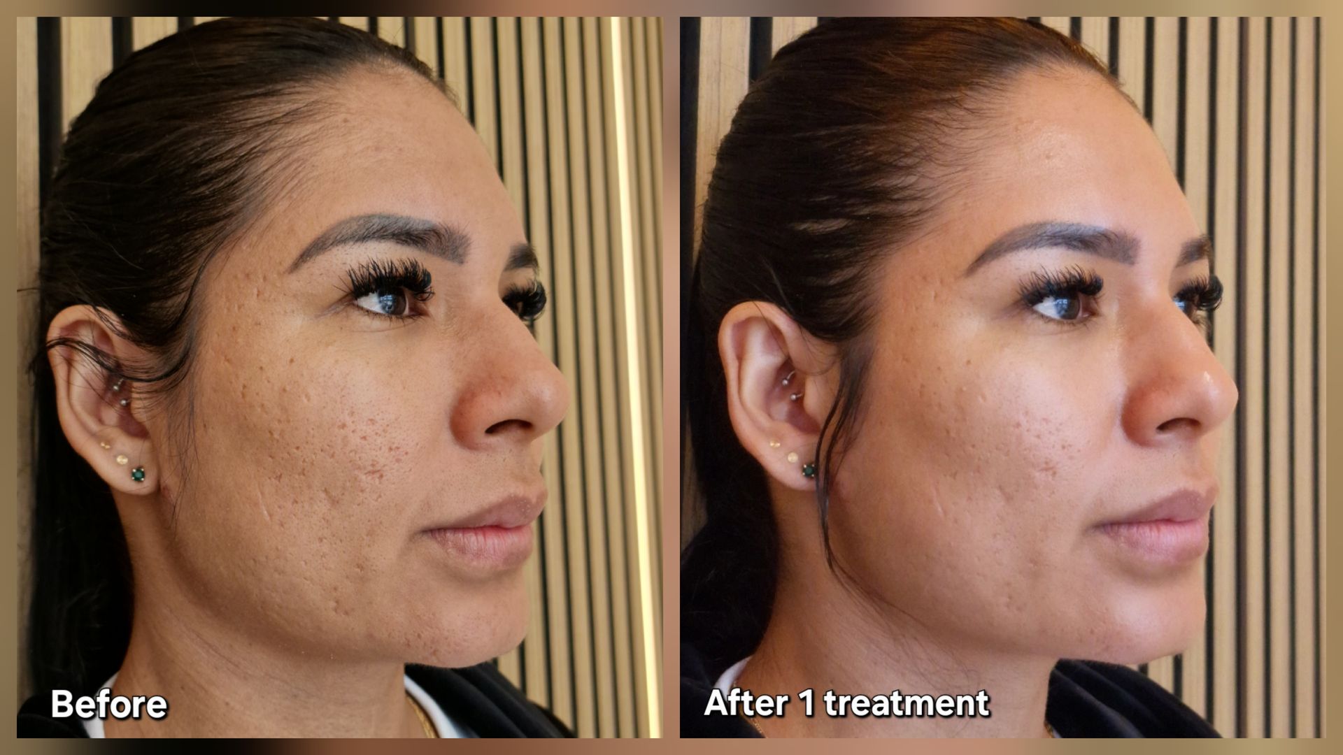 Hyperpigmentation 1