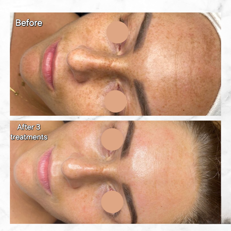 Oxygeneo Before and after