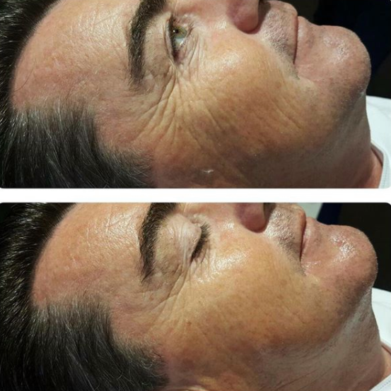 PhotoBiodynamic Therapy Acne Neck