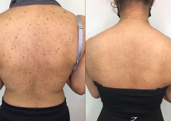 Before and After Acne 3