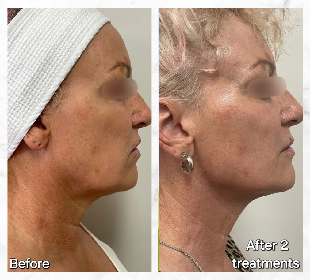 Before and after Hyperpigmentation 3