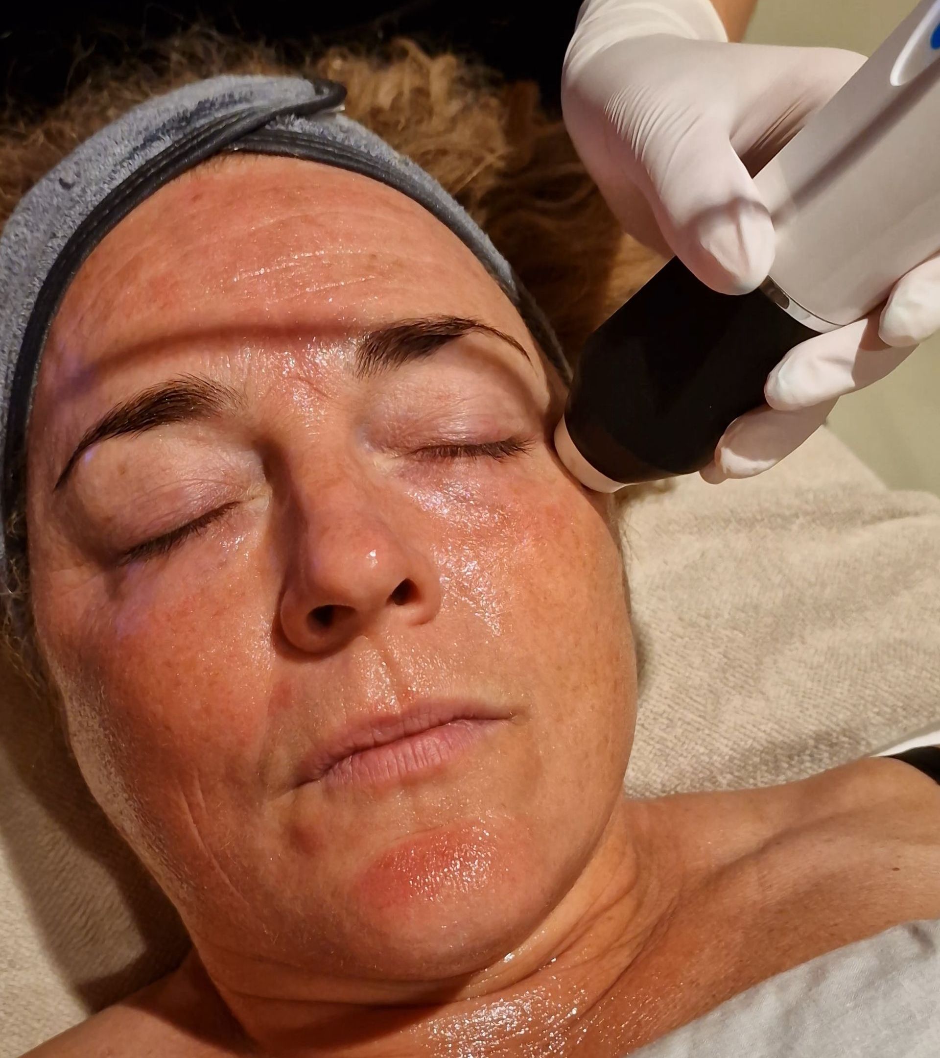 PhotoBiodynamic Therapy Acne Neck