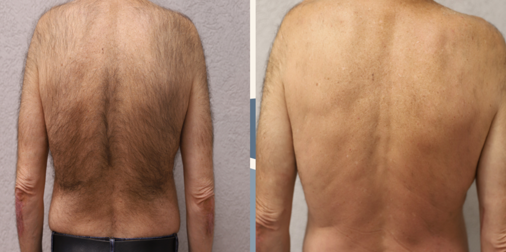 Before and after laser hair removal example 2