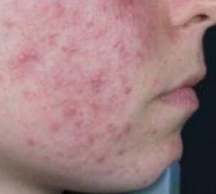 Acne Before Photobiodynamic treatment