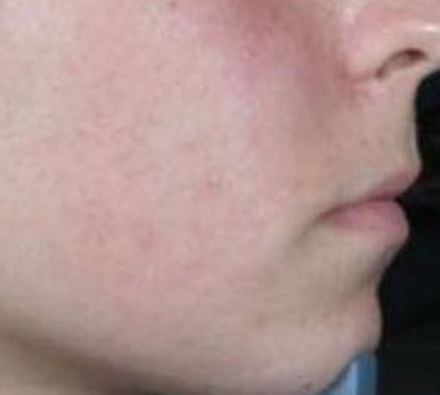 Acne after Photobiodynamic treatment