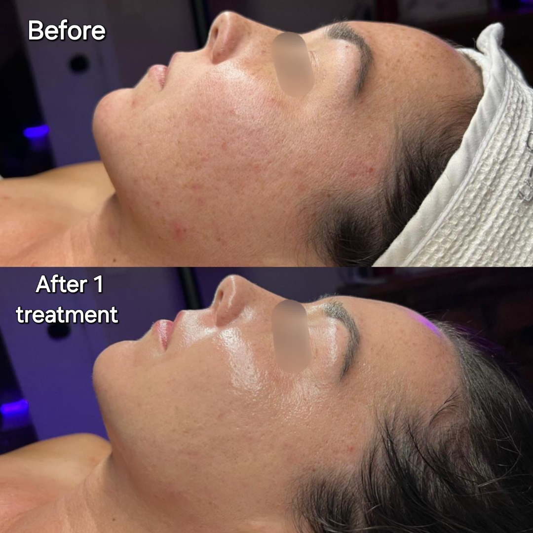 Before and After Acne 2