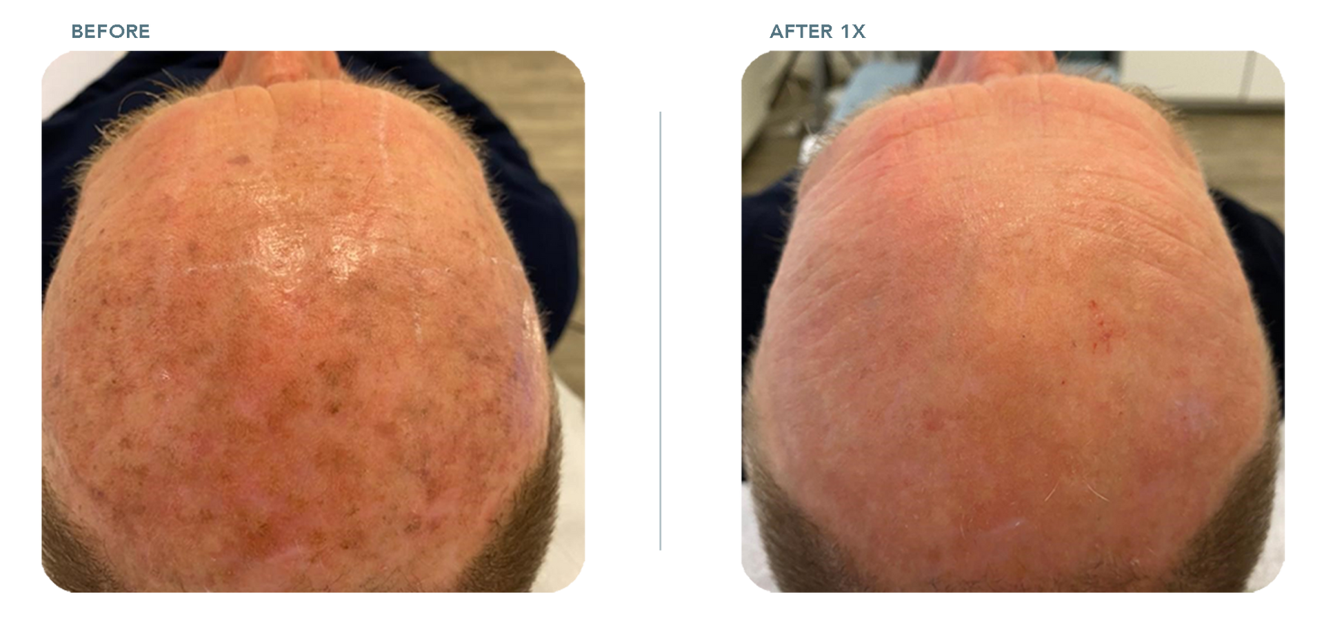 3d IPL laser on head