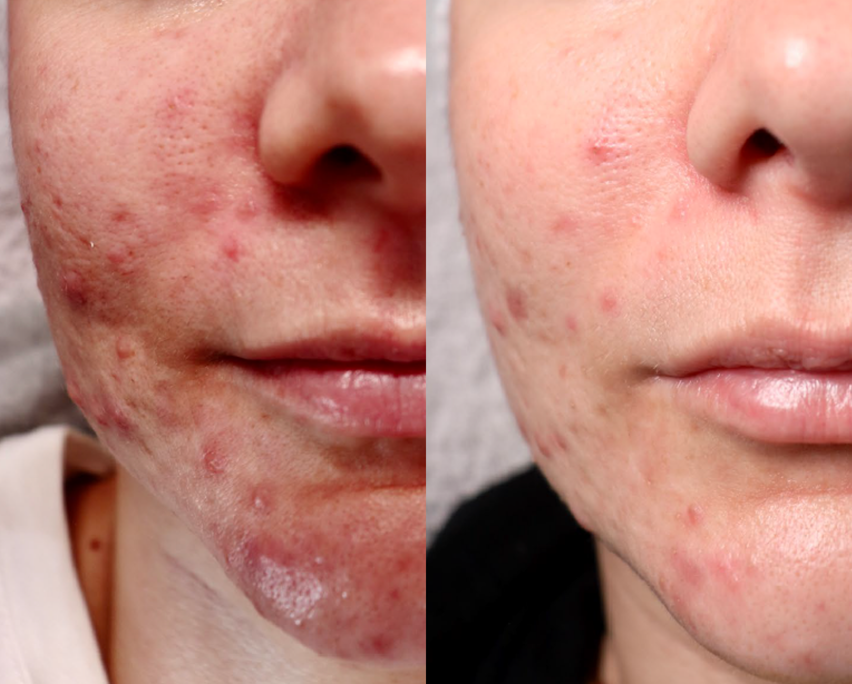 Acne Before and After