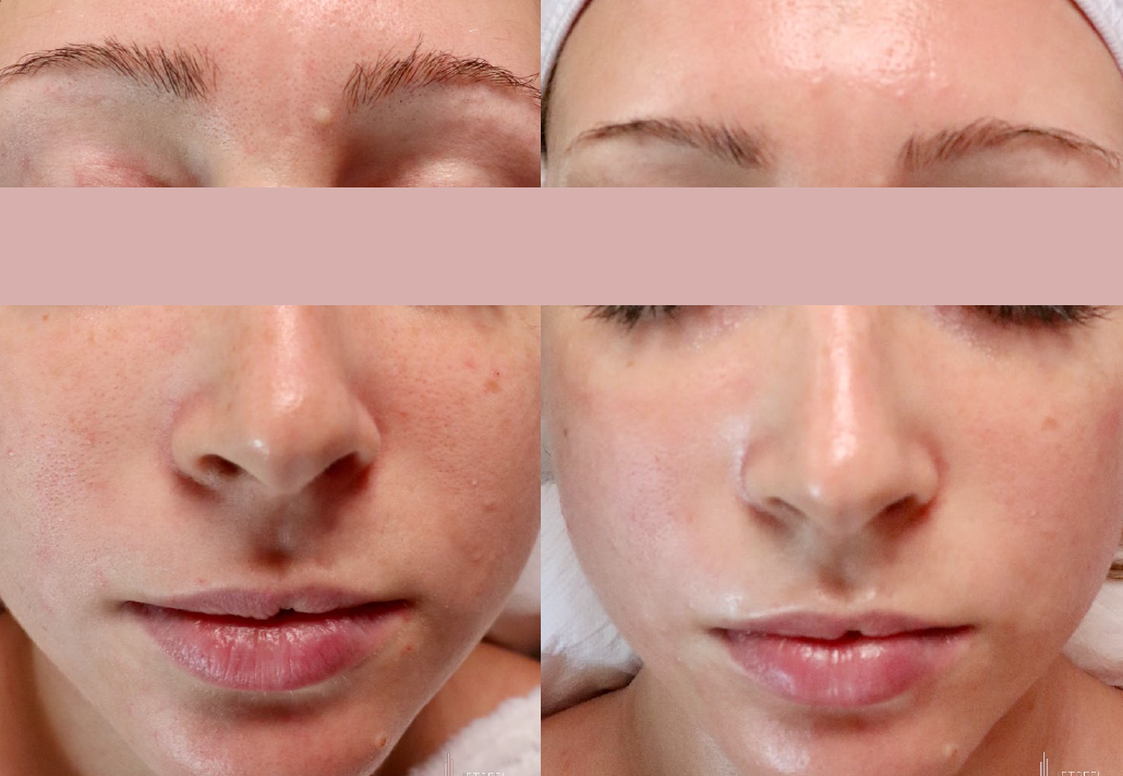 Jetpeel Pro Due Face before after