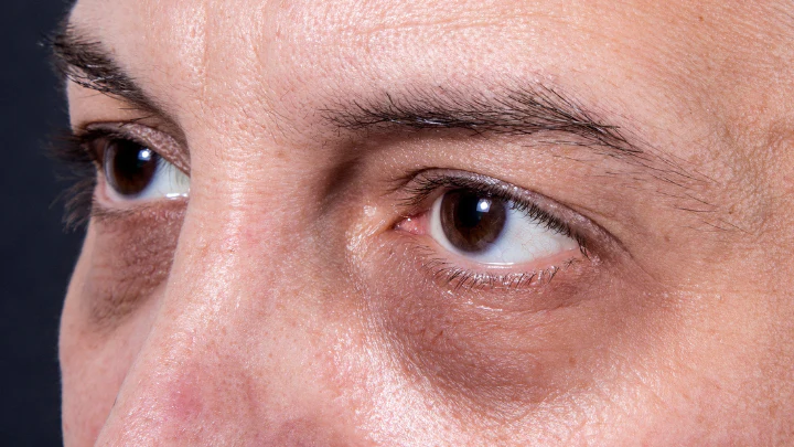 Men with dark circles under eyes