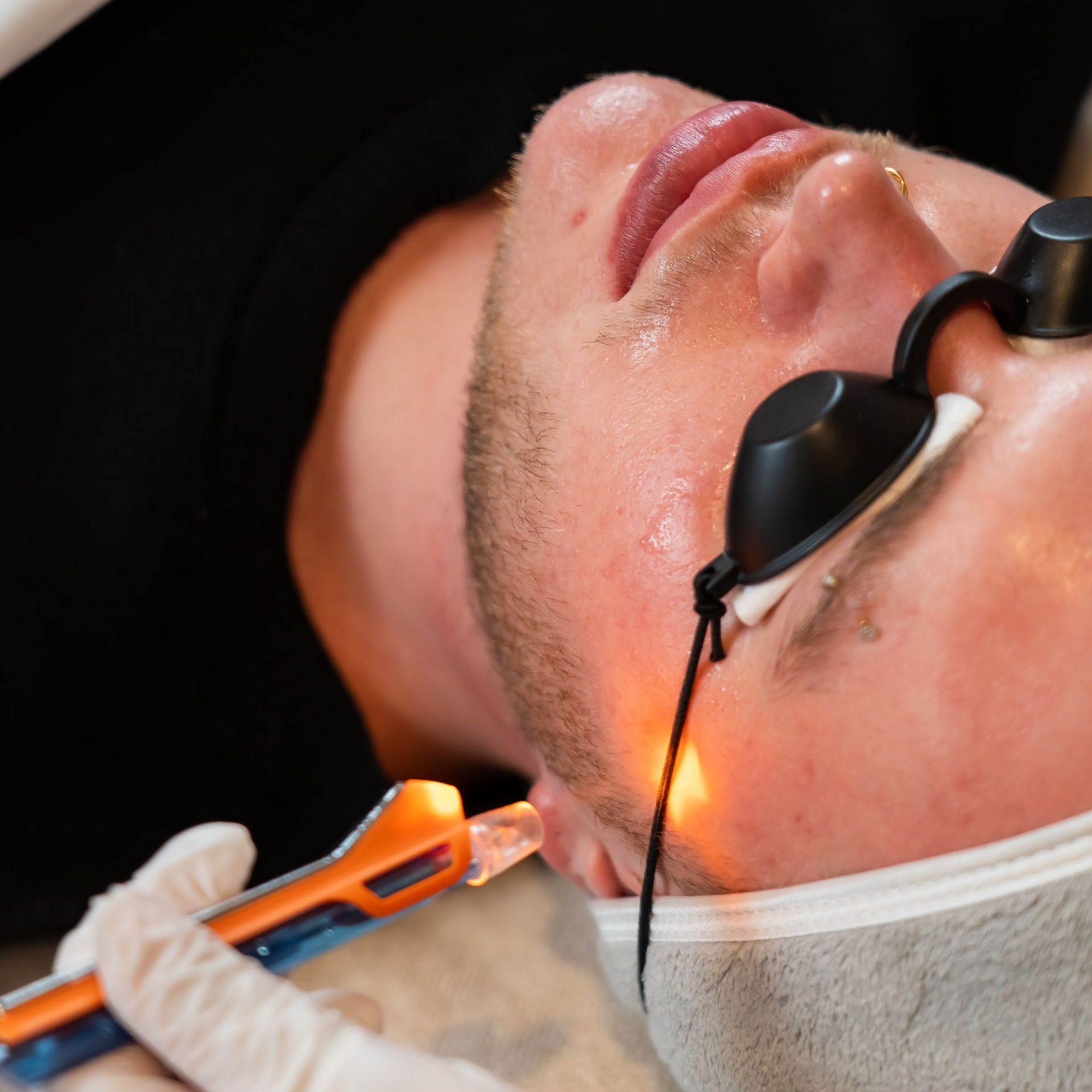 Men Skin Improvement treatments amsterdam