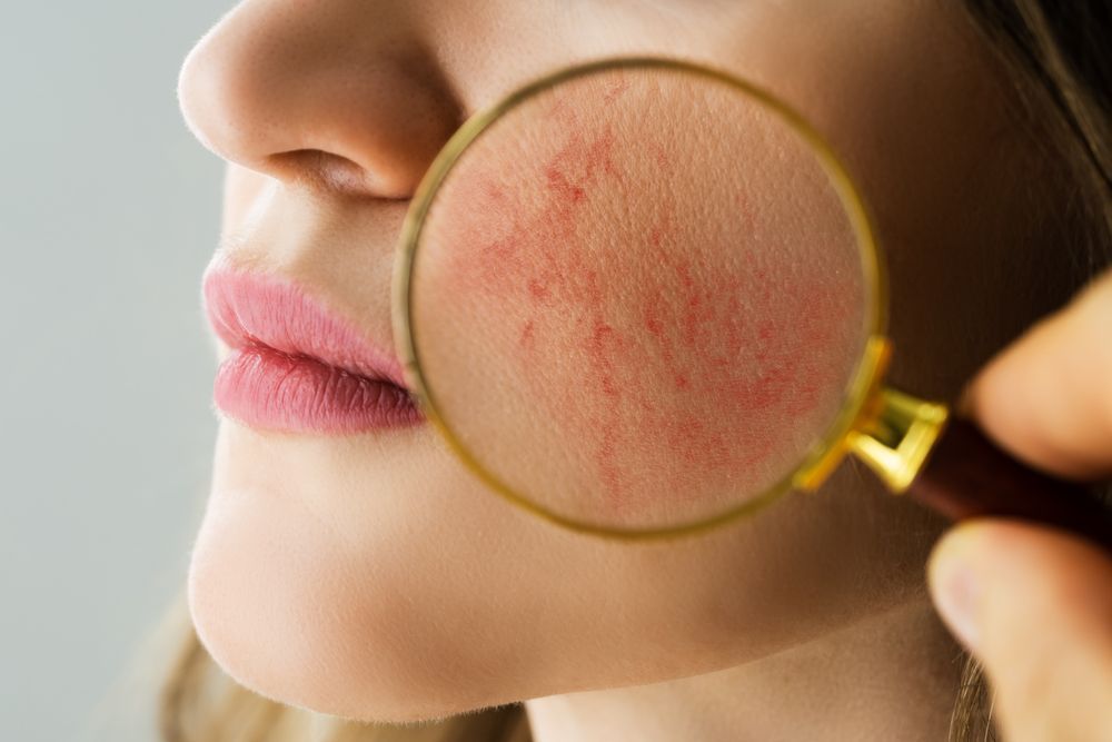 Rosacea or Couperose