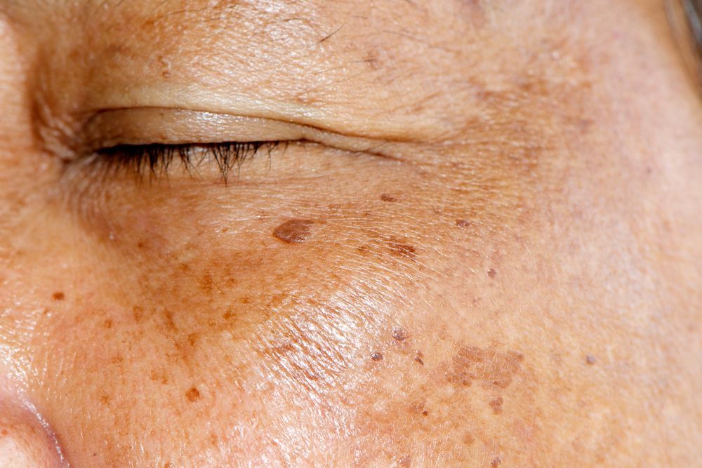 Hyperpigmentation and pigmentation spots