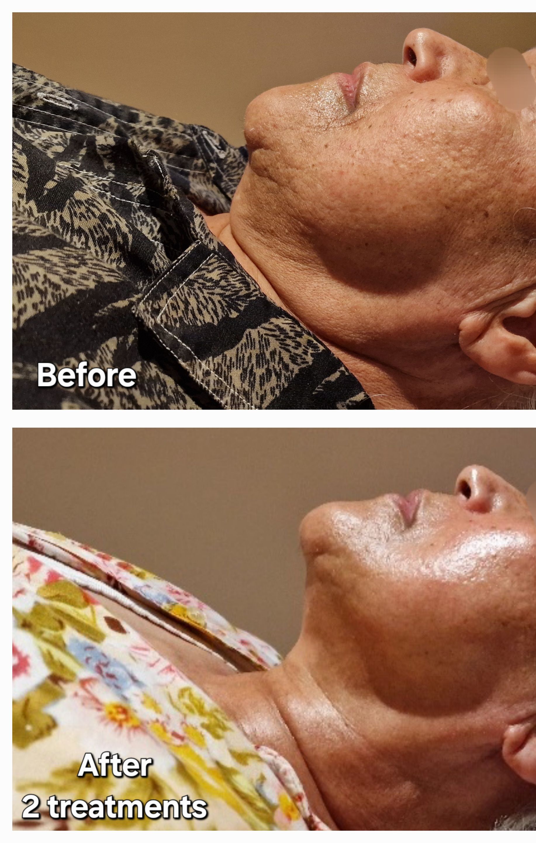 Voor en na Gustil Facial Lifting case 2