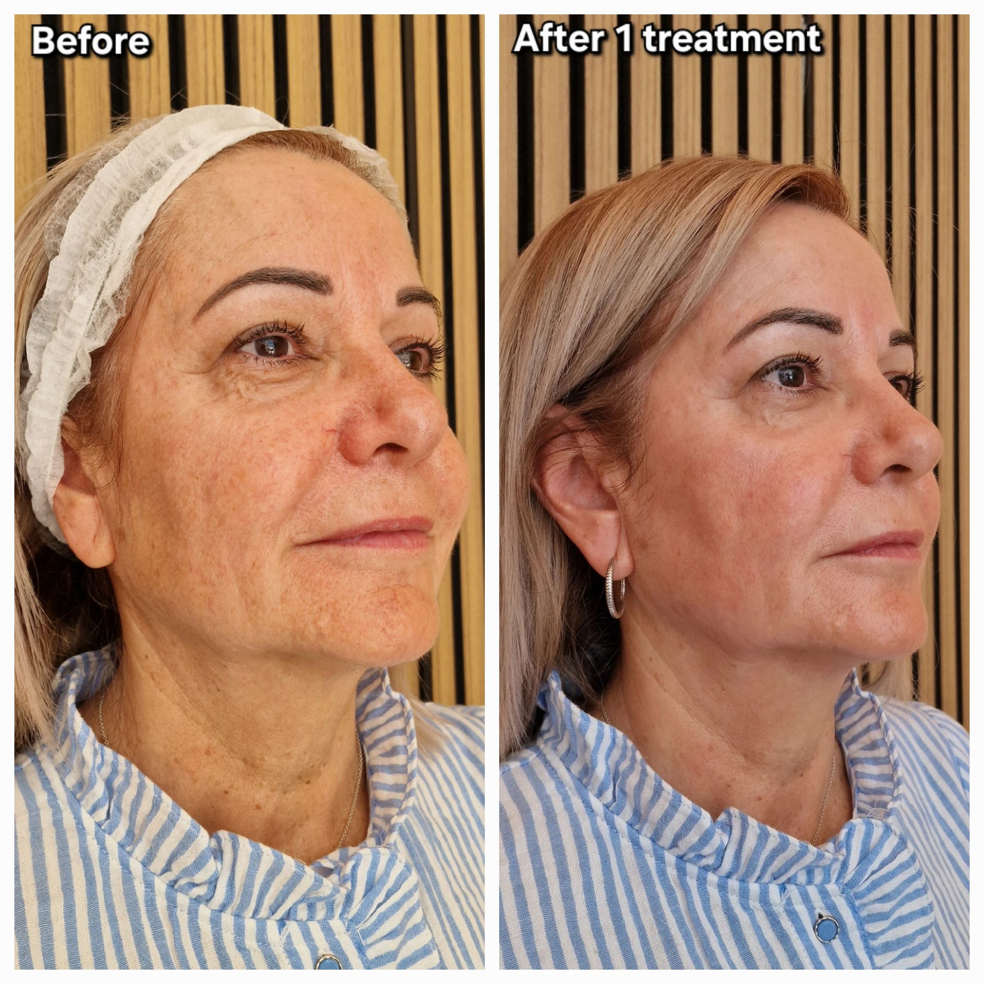 Voor en na Gustil Facial Lifting case 3